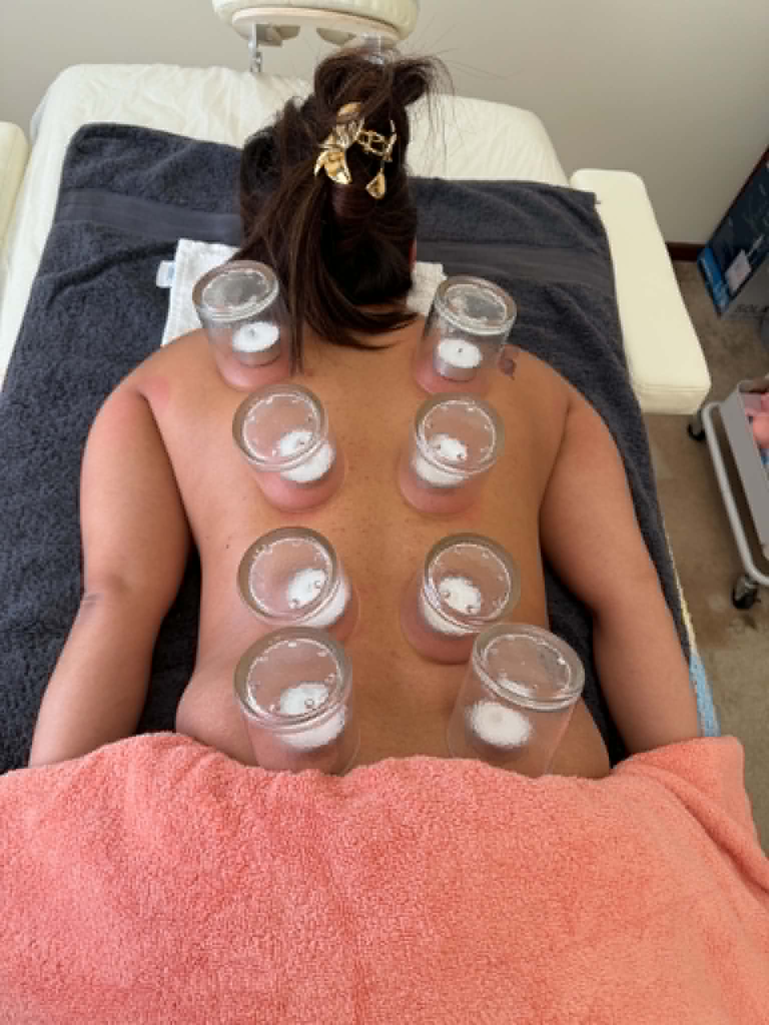 Ventosa cupping therapy treatment on the back